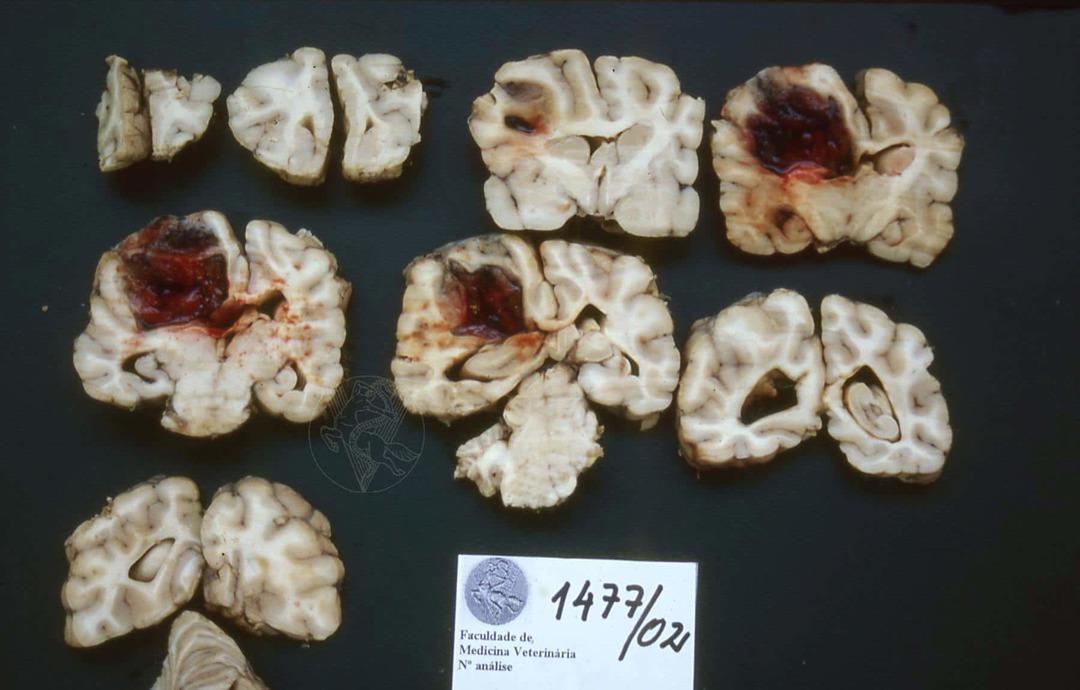 Astrocitom mozga i leđne moždine: što je to, simptomi, liječenje, prognoza