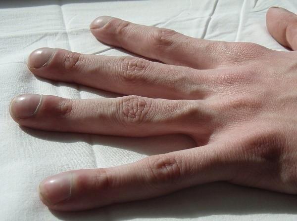 Cisztás fibrózisban szenvedő személy keze