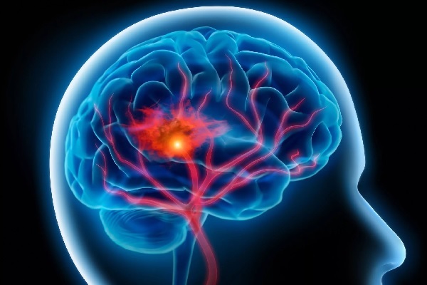 Mŕtvica s mozgovou krvácaním: znaky, príčiny, dôsledky