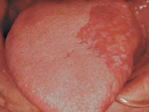 Erythroplasty usta