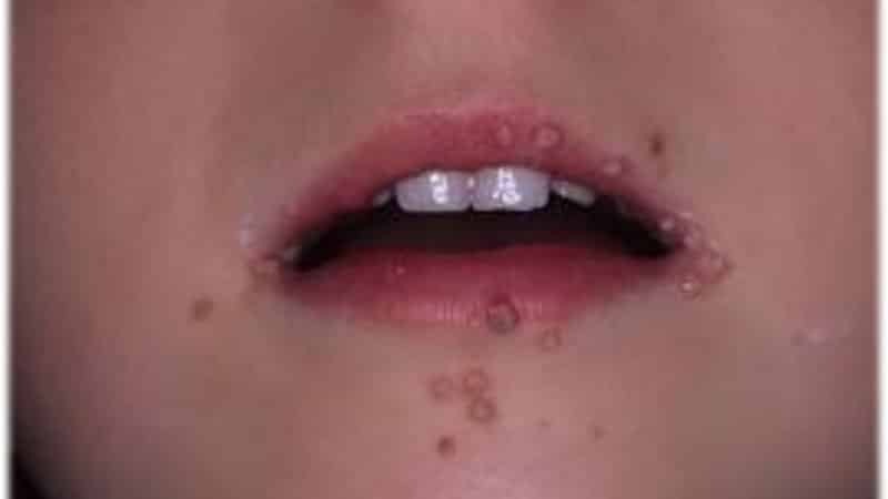 Zdravljenje papiloma usta