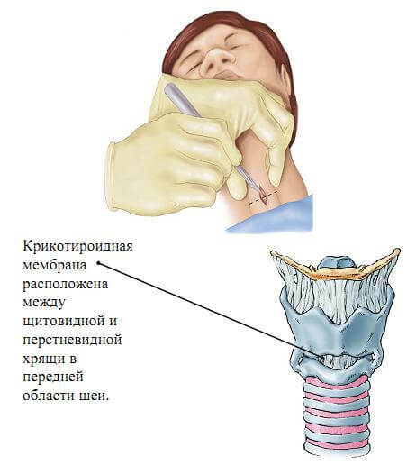 Foreign body of the larynx