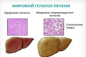 Hepatic_hepatococcosis symptoms