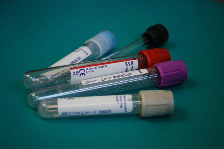Norma bilirubínu v krvi u mužov: ukazovatele testu súvisiace s vekom