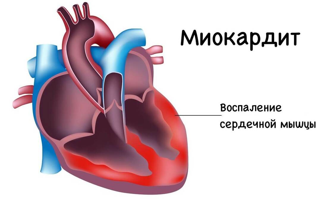Myocarditis van het hart: wat is het, symptomen en behandeling, complicaties, prognose