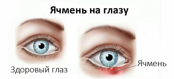 olhos celulite: sintomas e tratamento