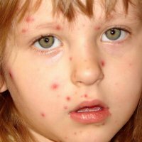 Sintomi di varicella nei bambini
