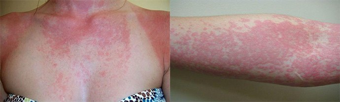 kožne manifestacije alergija