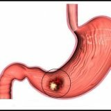 Prevention of gastric cancer