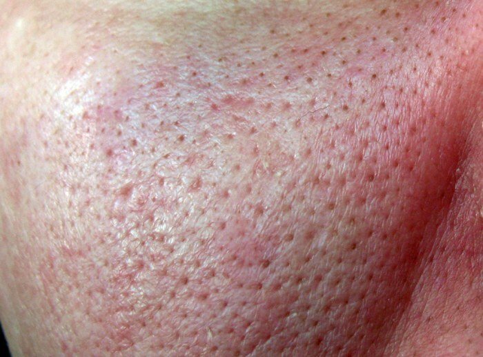Hoe zich te ontdoen van de post-acne: effectieve behandelingen