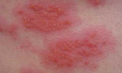 Allergic-contact-dermatitis-in-children-photo-0