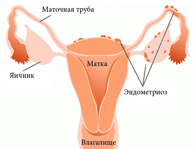 dijagnozu endometrioze