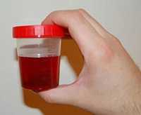 Urine with pyelonephritis
