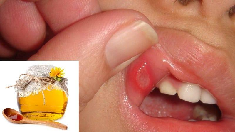 Honig mit Stomatitis bei Kindern: Behandlung und Prävention