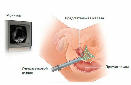 Ultrasound of the prostate: preparation, evidence, the essence of the procedure