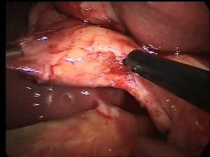 Chronische cholecystitis