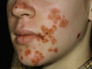 Signs of Streptococcal Infection