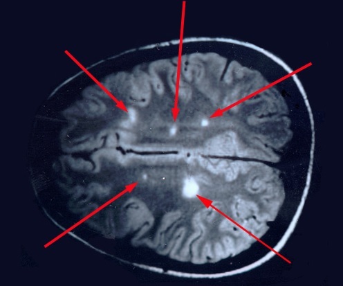 MRI of the brain is done