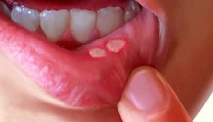 genezen zweren in de mond bij volwassenen