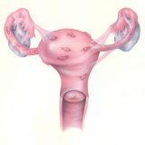 Endometrioza: Simptomi i liječenje