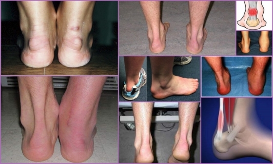 Achilles Bursitis: Ursachen, Symptome, Behandlung, Fotos
