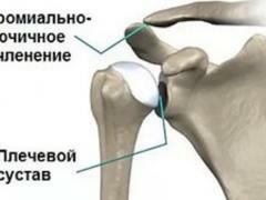Arthrose joint acromio claviculaire