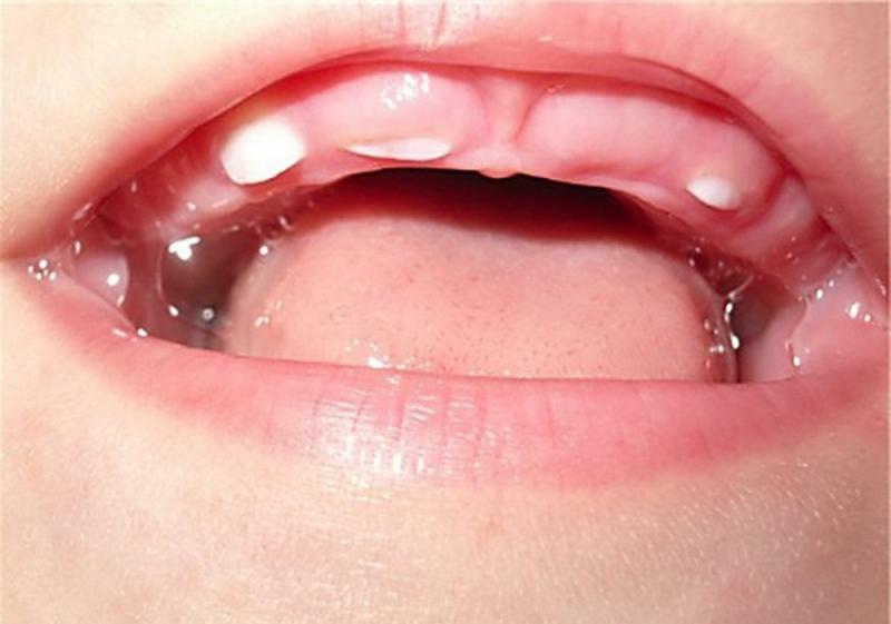 nombre de dents en 2 ans