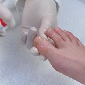 Spray anti-schimmel-nagels-on-legs