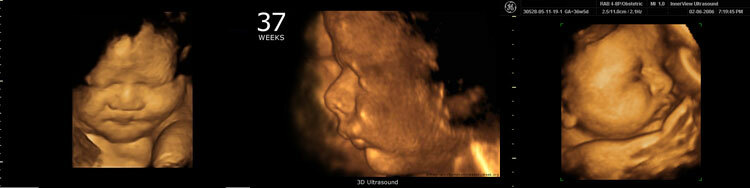 Ultrazvuk do 37 tjedna trudnoće