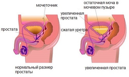 Kongestiver Prostatitis: Was die charakteristischen Merkmale der Strömung hat