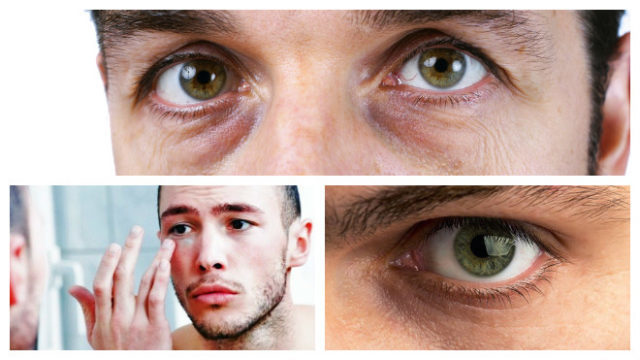 Hvorfor får menn blåmerker under øynene?