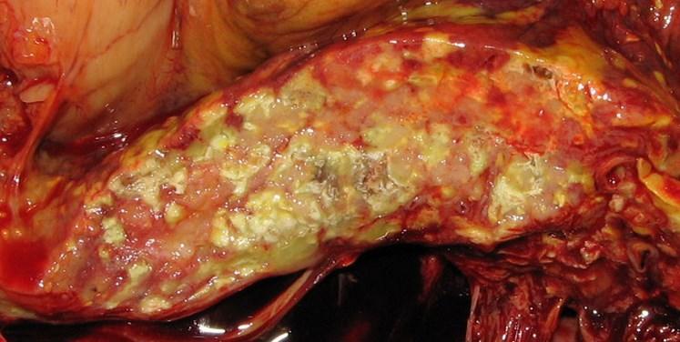 Mastná nekróza pankreasu