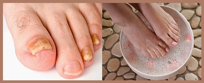 Kako zmehčati nohte na nogah z glivicami doma: ljudska zdravila