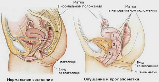 Uitlaten van de baarmoeder