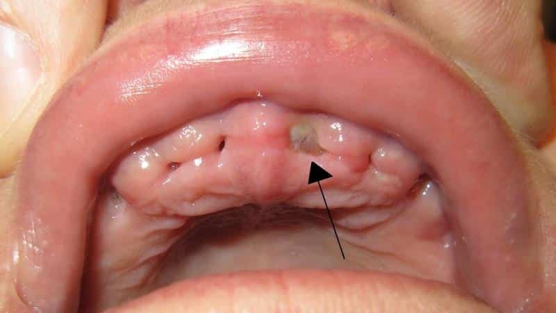 Inflammation after tooth extraction treatment