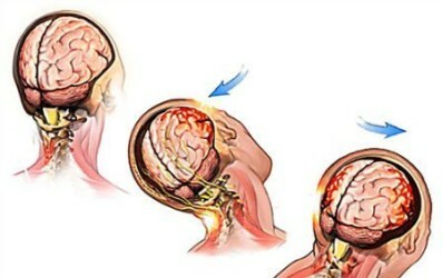 Hoe is een hersenschudding gemanifesteerd?