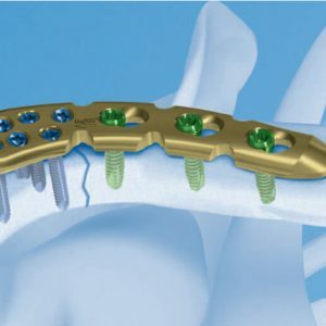 Osteosintēze plate-pri-atslēgas kaula lūzumi