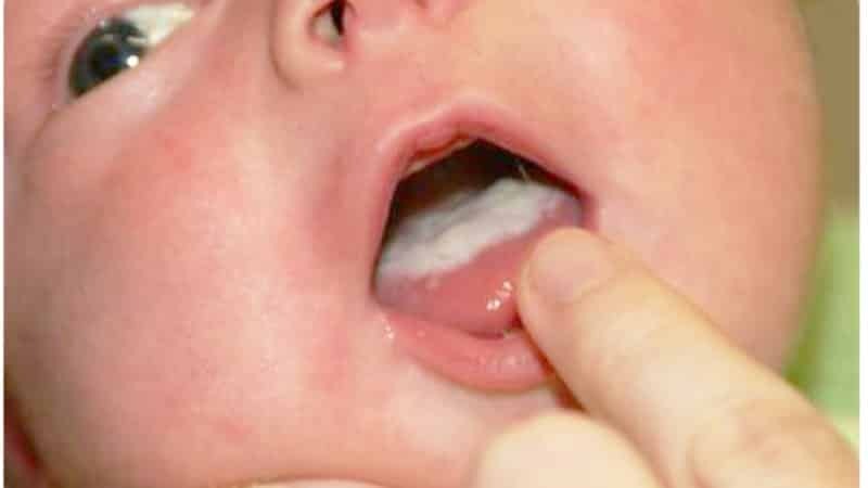 bijele mrlje u usta novorođenog fotografiju