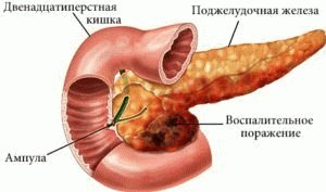 Pankrease haigus