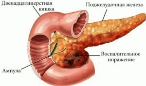 Hur man återställer bukspottkörteln vid kronisk pankreatit