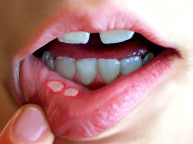Miramistin z jamy ustnej u dzieci i dorosłych - opcje aplikacji