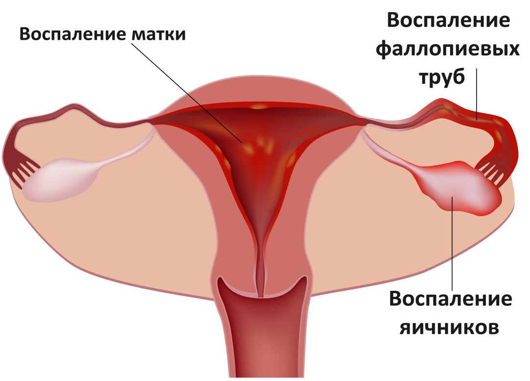 Salpingitis: symptomen en behandeling bij vrouwen, oorzaken