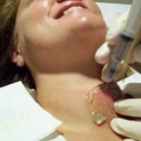 Cirugía mínimamente invasiva de la tiroides