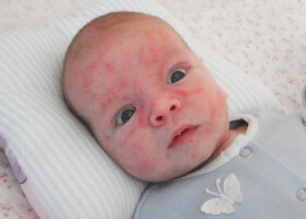 Alergia em um bebê