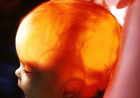 Forøgelse i hjernens ventrikler i fosteret