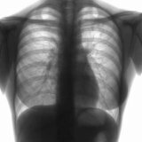 Fokaalne tuberkuloos: sümptomid, ravi