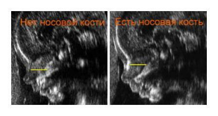 Qu'est-ce qu'il est et comment déterminer le syndrome de Down par ultrasonographie