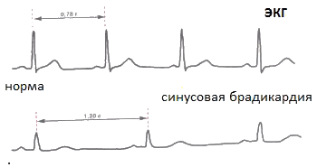 Fig.2 - Bradykardi på EKG