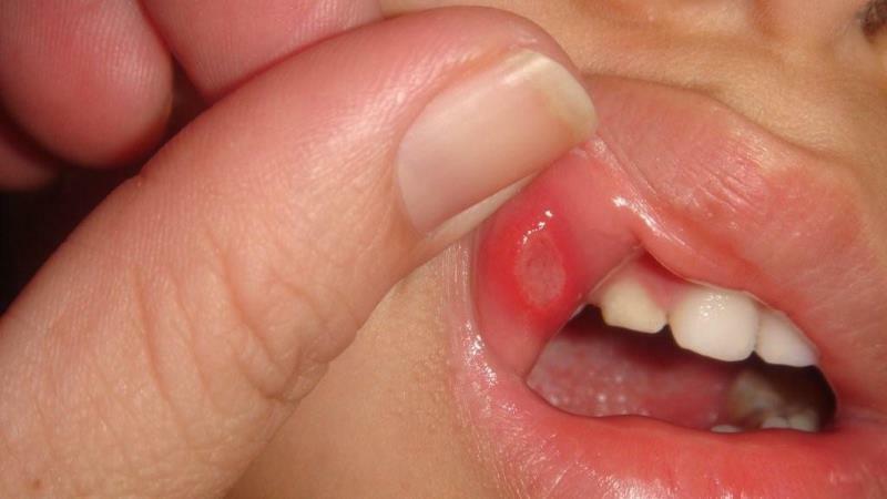Erkrankungen der Mundschleimhaut Mund Foto
