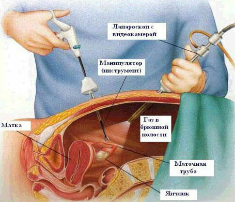 laparoskopija